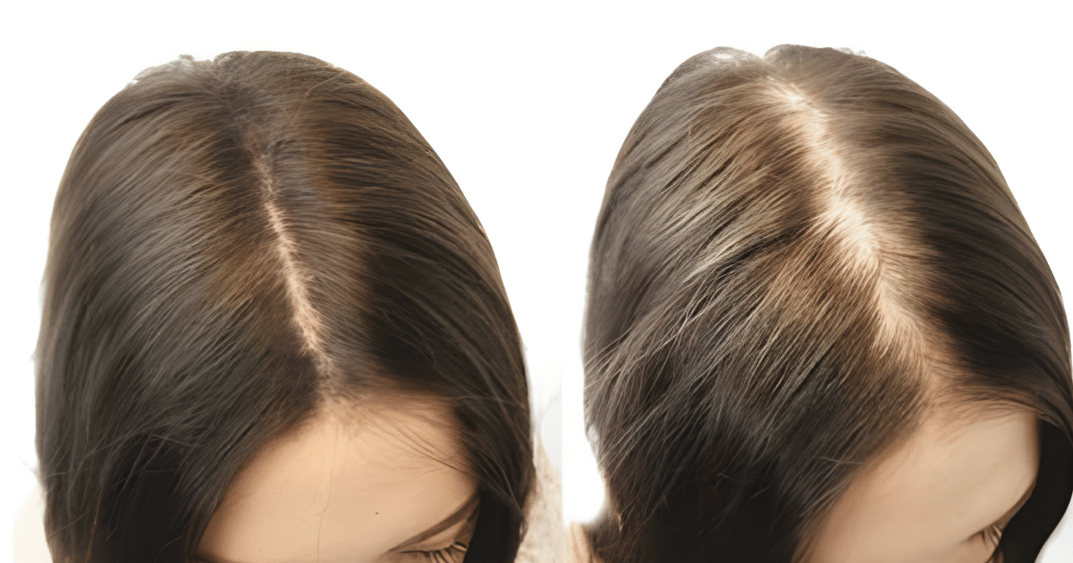 La riga dei tuoi capelli si sta allargando? Ecco cosa potrebbe stare succedendo — e cosa fare al riguardo