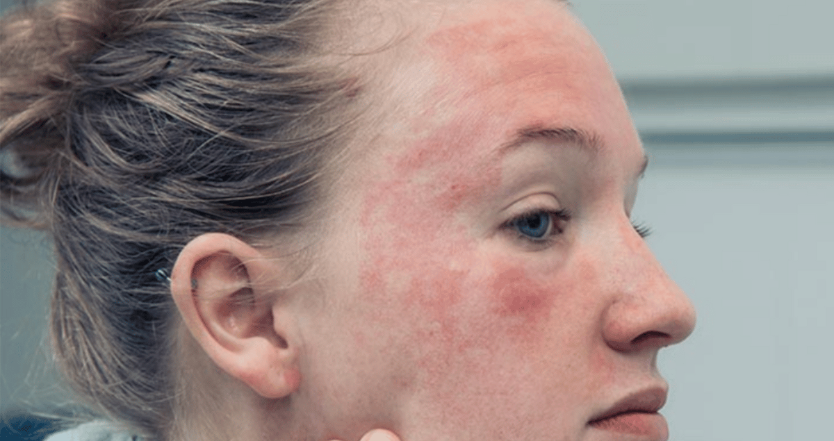 Perché le eruzioni cutanee sembrano peggiorare in inverno e cosa nessuno ammette sul microclima domestico